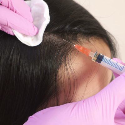 Hair transplant in Hazratganj Lucknow