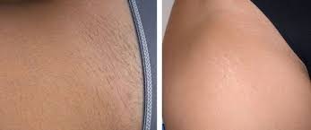 Bikni Line Laser hair Removal in Lucknow